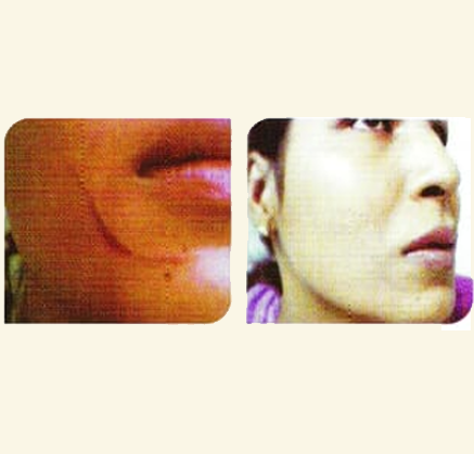 Scar Removal Treatment